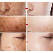 Effective Whitening Freckle Face Cream Remove Dark Melanin Improve Dullness Skin Care