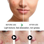 Powerful Freckle Removal Cream