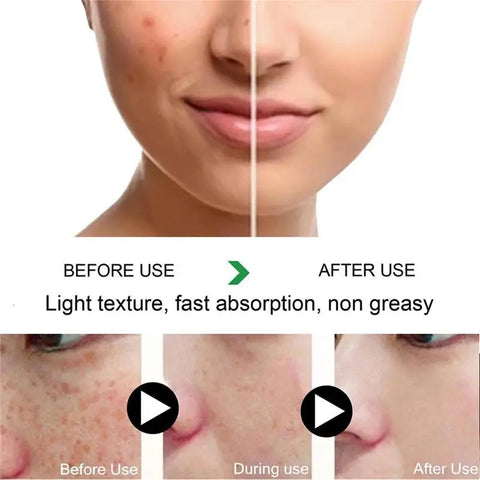 Powerful Freckle Removal Cream