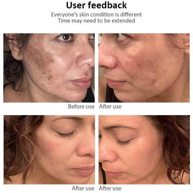 Powerful Freckle Removal Cream