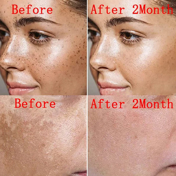 Effective Whitening Freckle Face Cream Remove Dark Melanin Improve Dullness Skin Care